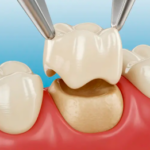 Ceramic Tooth Cap