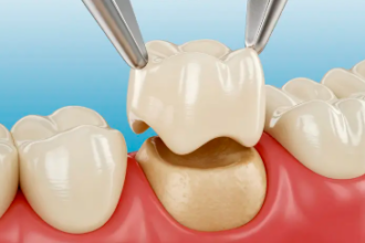 Ceramic Tooth Cap