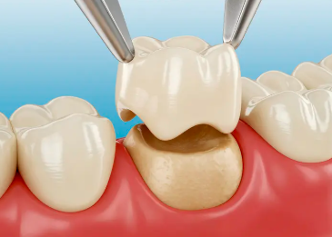 Ceramic Tooth Cap