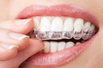 Invisible Aligners Cost in India: A Realistic Guide Before You Decide