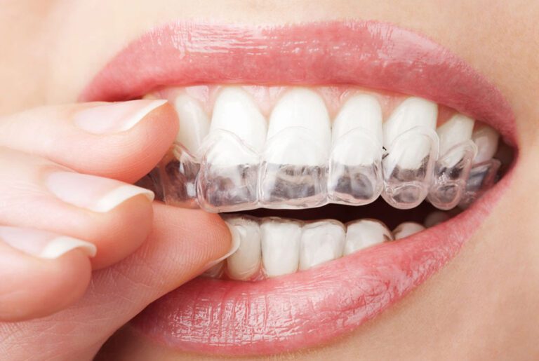 Invisible Aligners Cost in India: A Realistic Guide Before You Decide