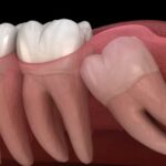 Wisdom Teeth Removal