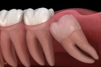 Wisdom Teeth Removal